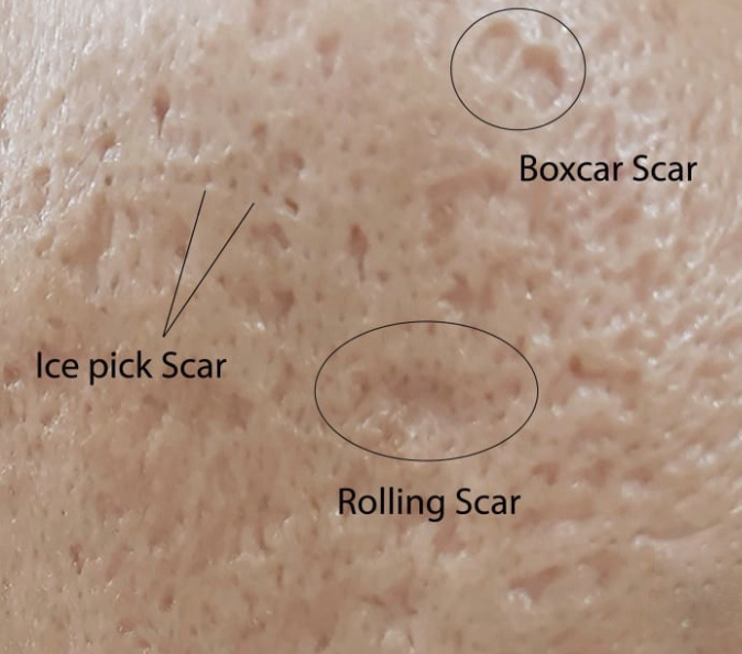 Types of acne scars including ice pick, boxcar, and rolling scars on facial skin